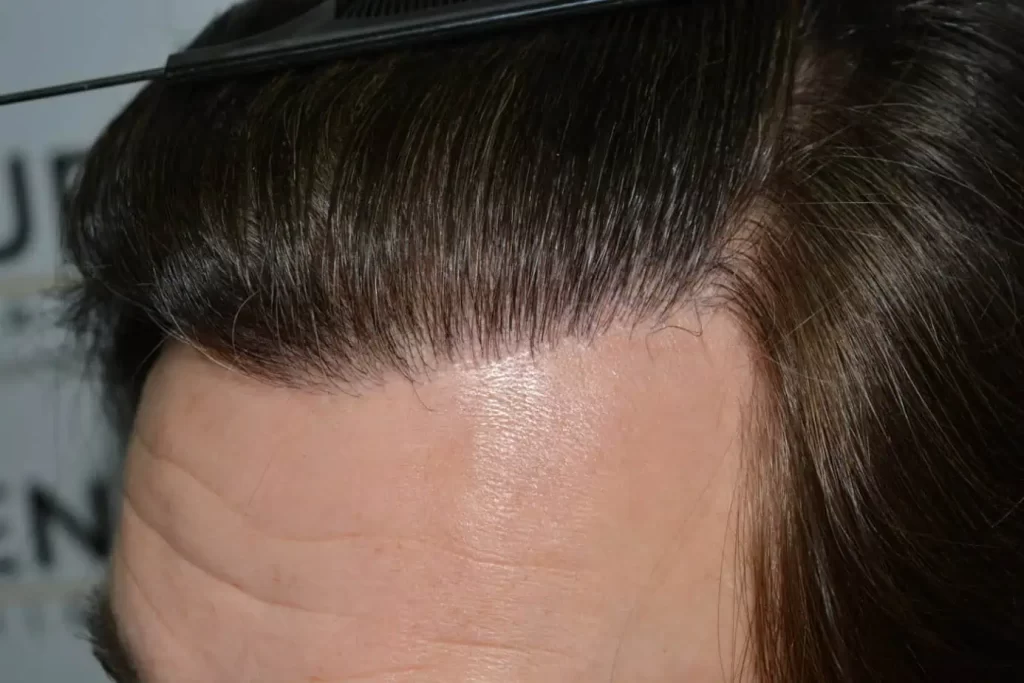 From Failed Hair Transplant To Shah Rukh Khan