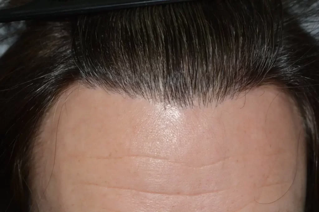 From Failed Hair Transplant To Shah Rukh Khan