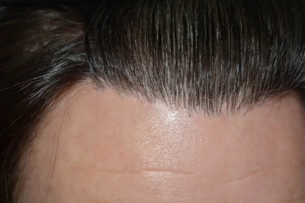 From Failed Hair Transplant To Shah Rukh Khan
