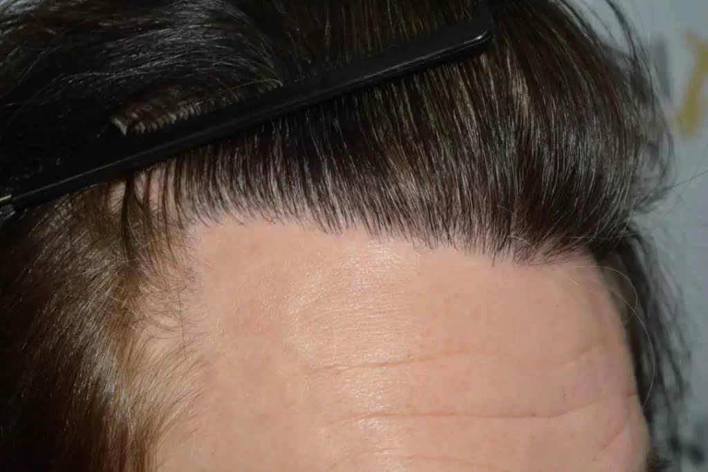 From Failed Hair Transplant To Shah Rukh Khan
