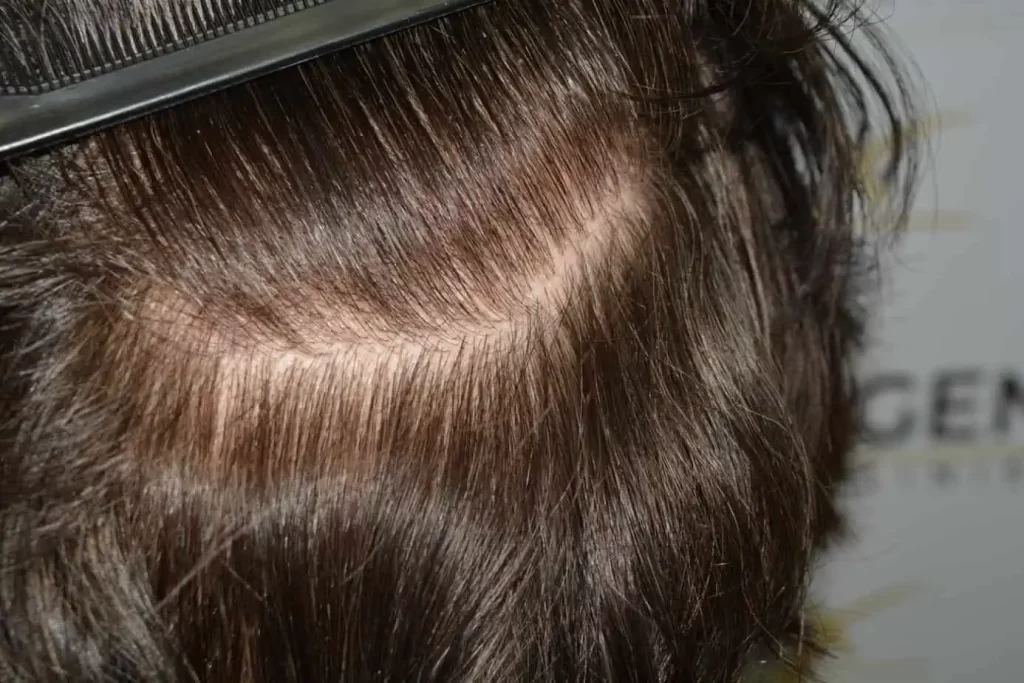 From Failed Hair Transplant To Shah Rukh Khan