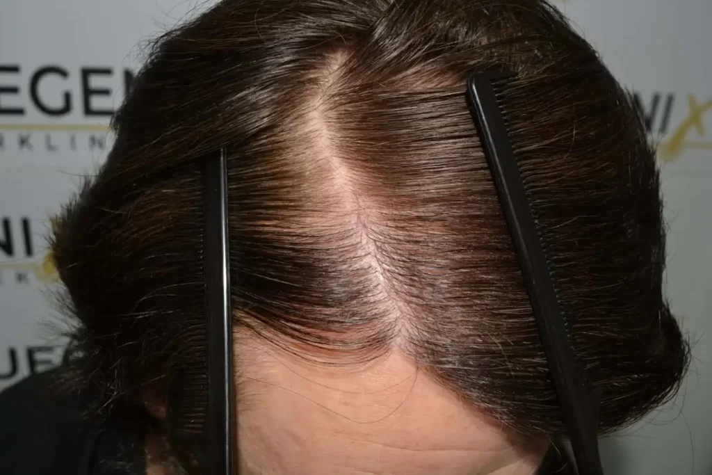 From Failed Hair Transplant To Shah Rukh Khan