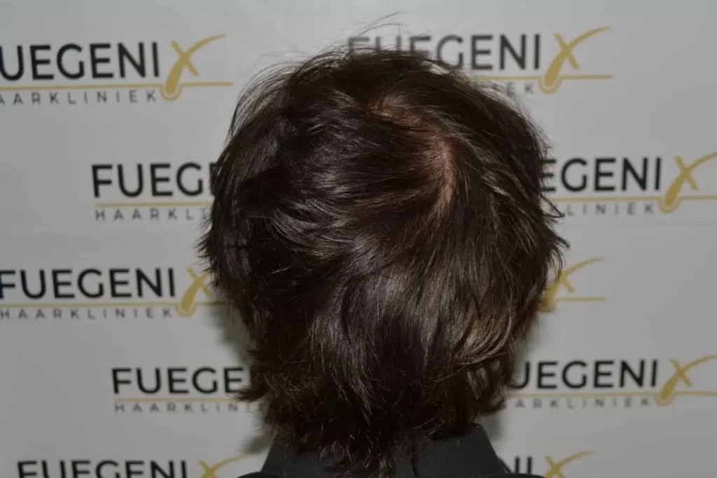 From Failed Hair Transplant To Shah Rukh Khan