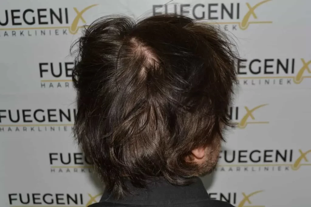 From Failed Hair Transplant To Shah Rukh Khan