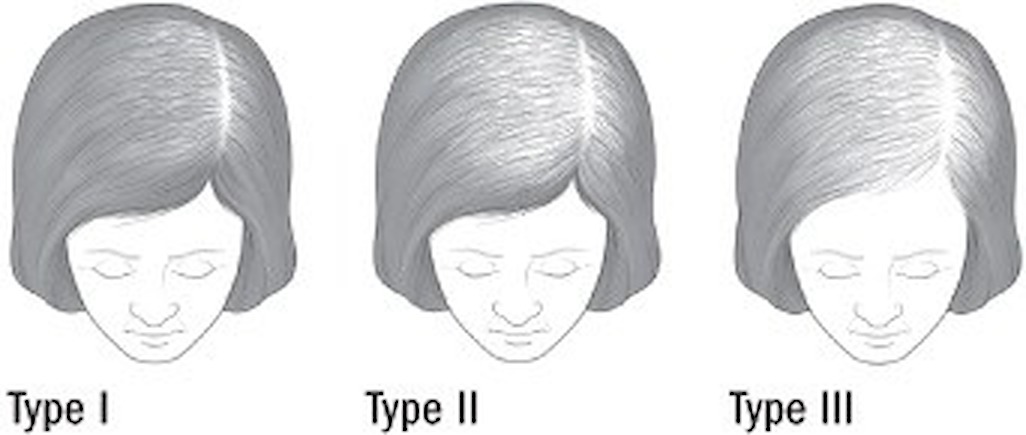 Diagram of the patterns of hair loss in women