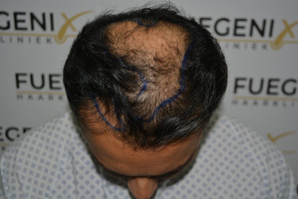 Hairline Midscalp Crown