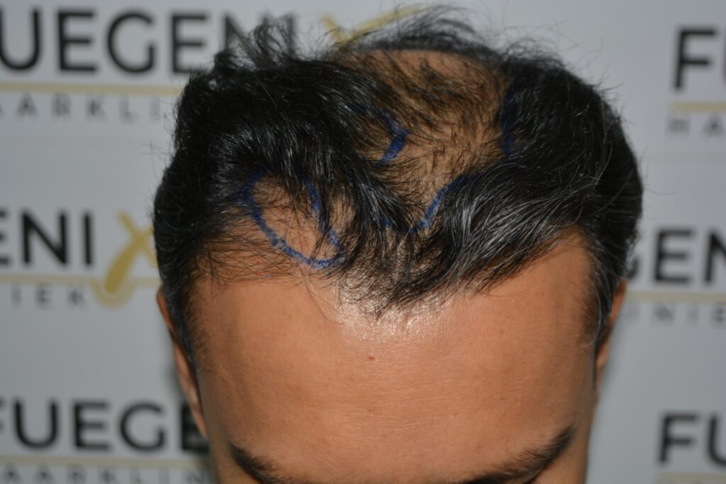Hairline Midscalp Crown
