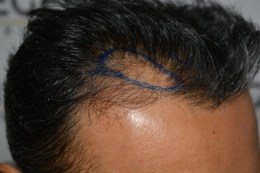 Hairline Midscalp Crown