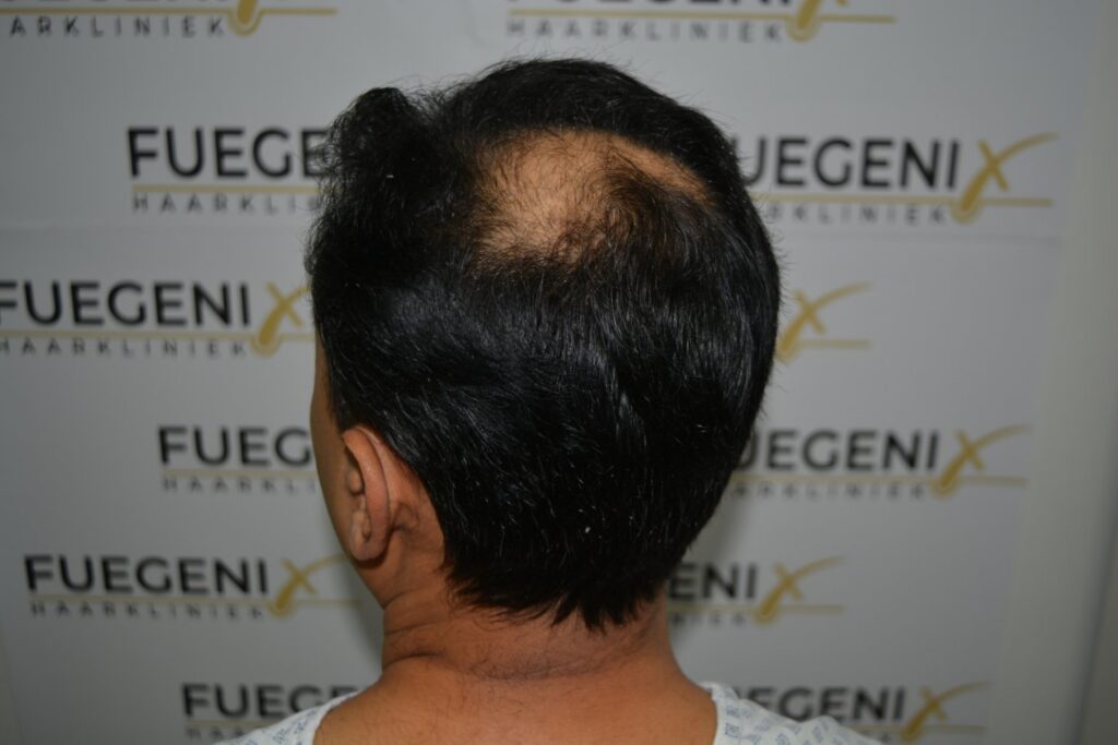 Hairline Midscalp Crown