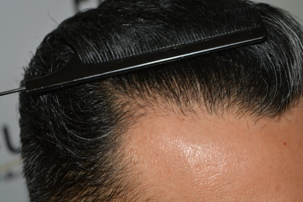 Hairline Midscalp Crown