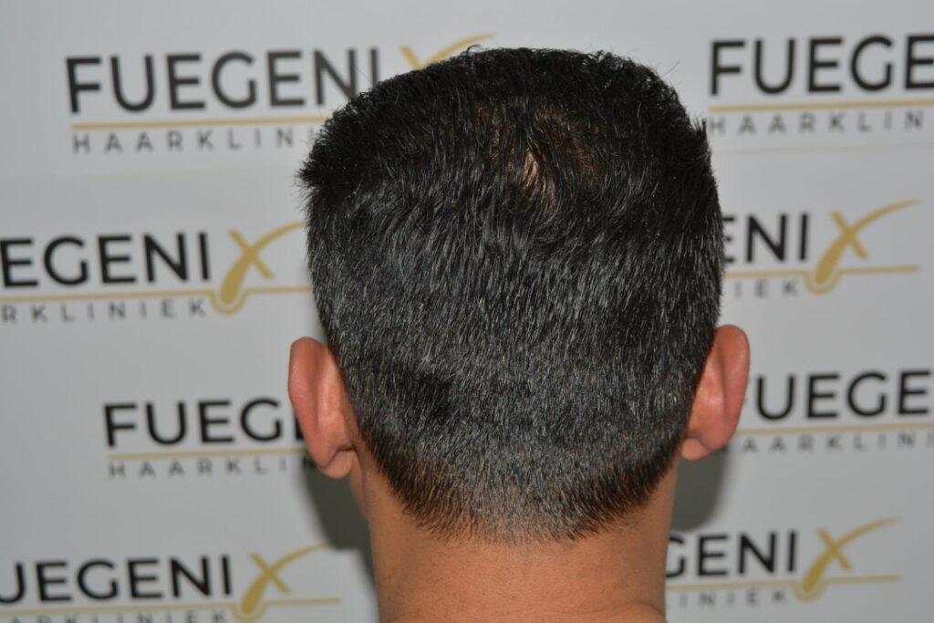 Hairline Midscalp Crown