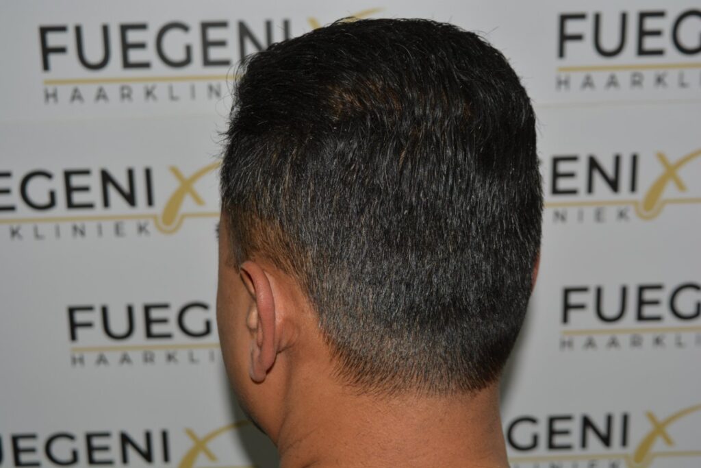 Hairline Midscalp Crown