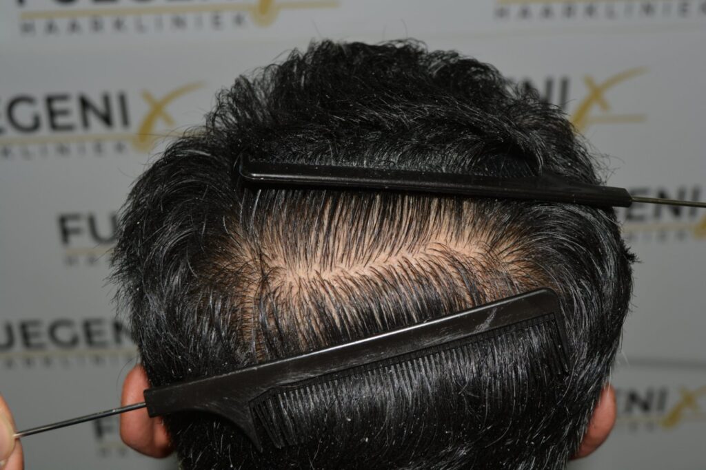 Hairline Midscalp Crown