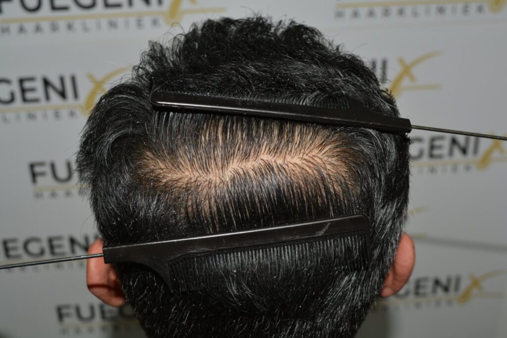 Hairline Midscalp Crown