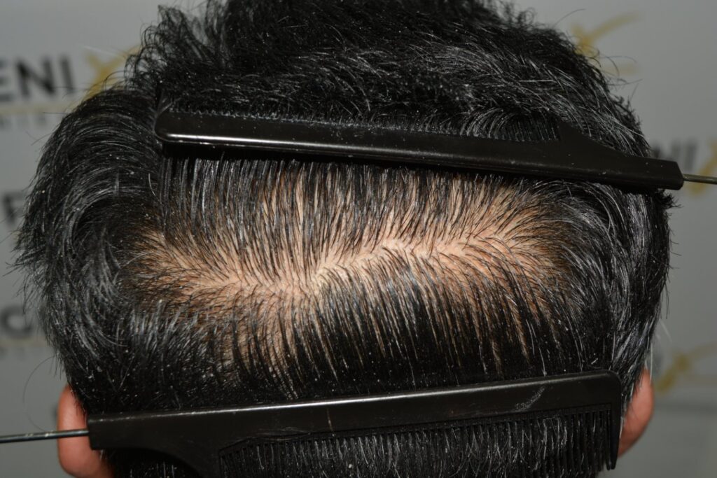 Hairline Midscalp Crown