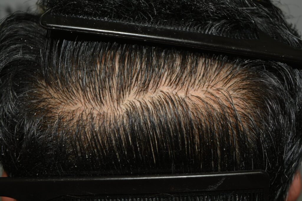 Hairline Midscalp Crown