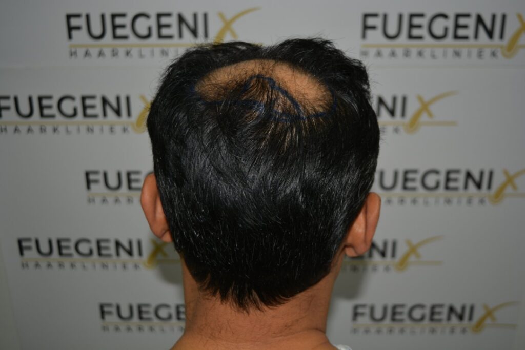 Hairline Midscalp Crown