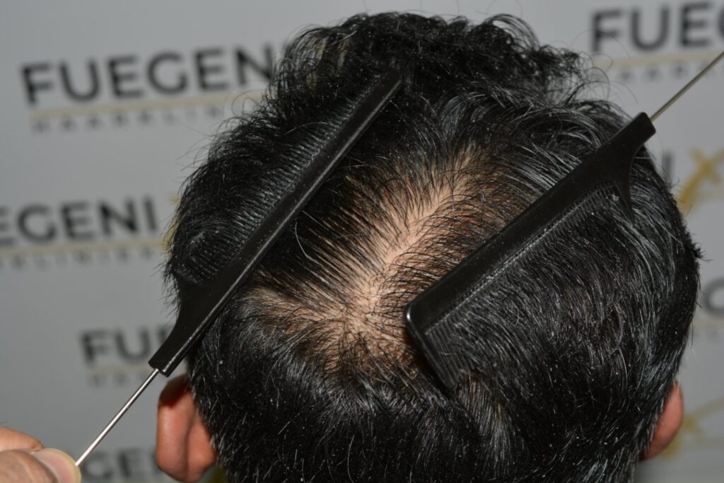 Hairline Midscalp Crown