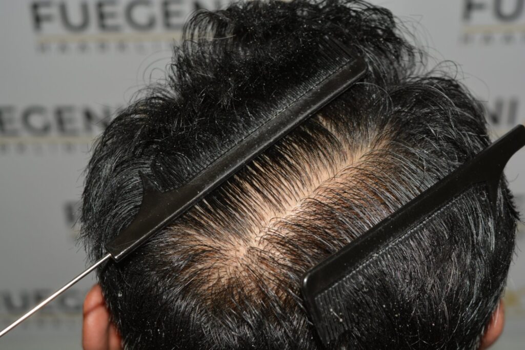 Hairline Midscalp Crown