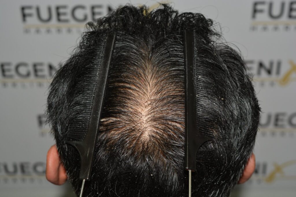 Hairline Midscalp Crown