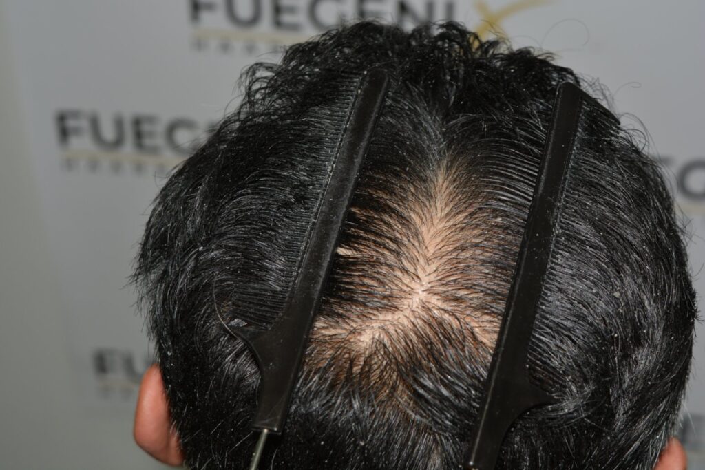 Hairline Midscalp Crown