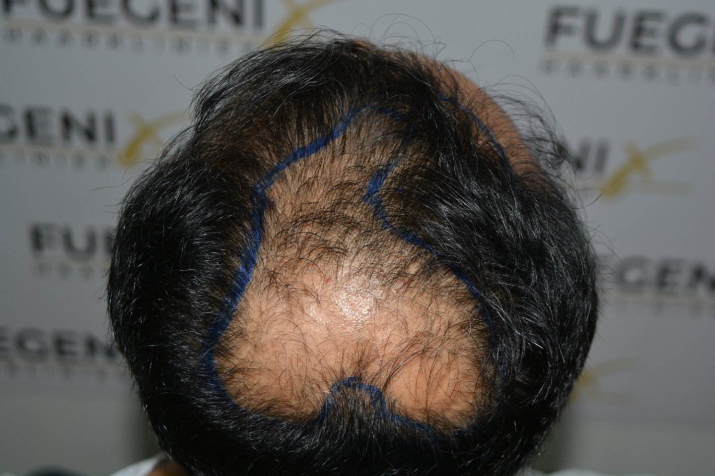 Before – Hairline Midscalp Crown
