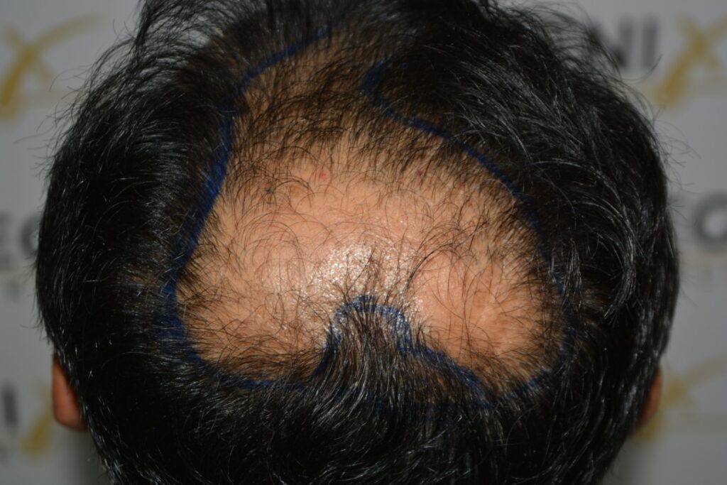 Hairline Midscalp Crown
