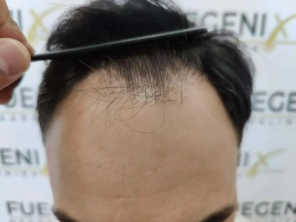 The Bollywood Hairline