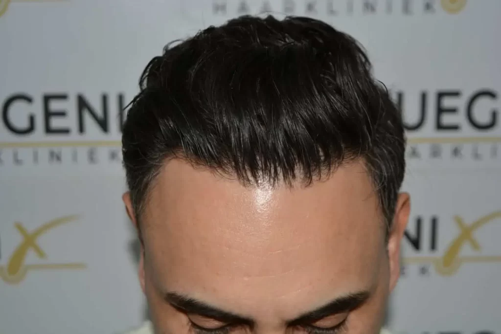 The Bollywood Hairline