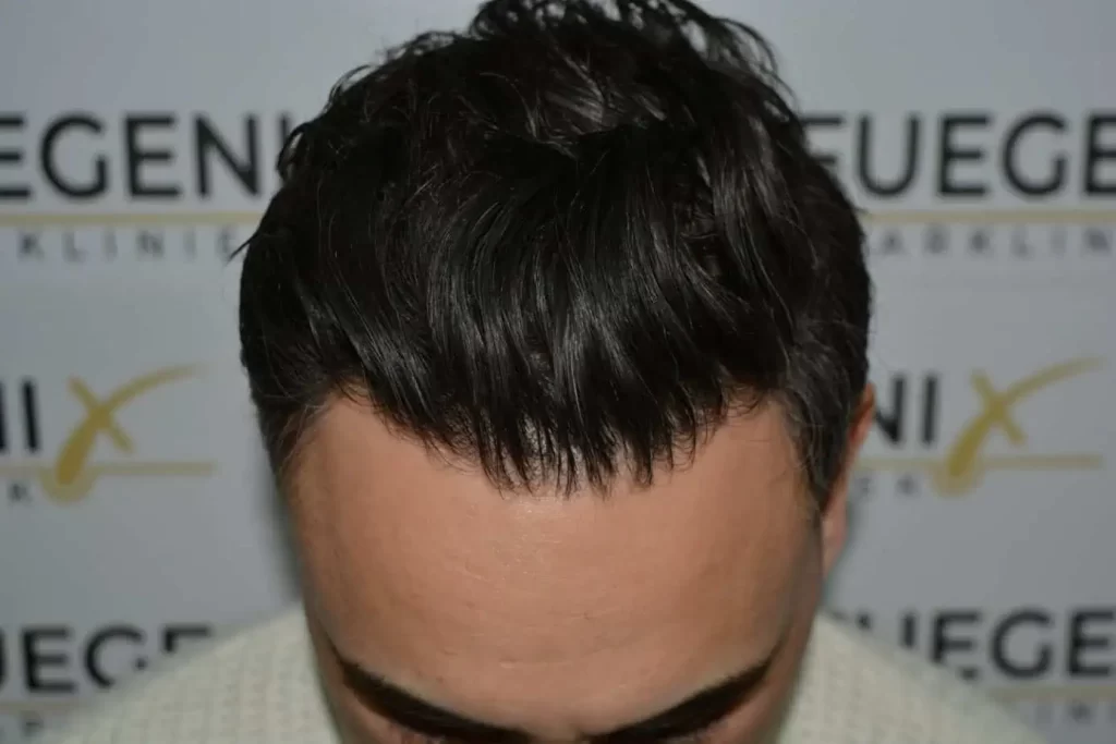 The Bollywood Hairline
