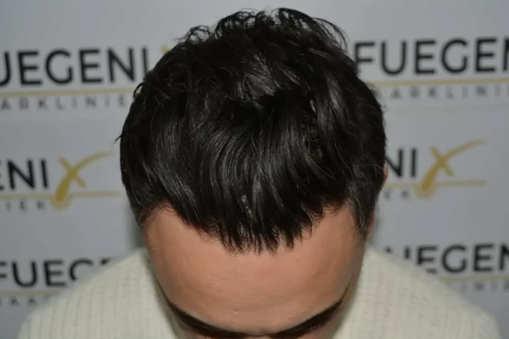 The Bollywood Hairline