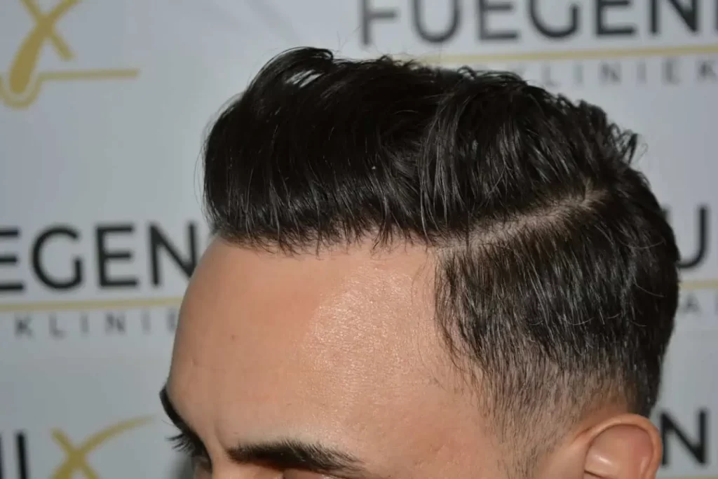 The Bollywood Hairline