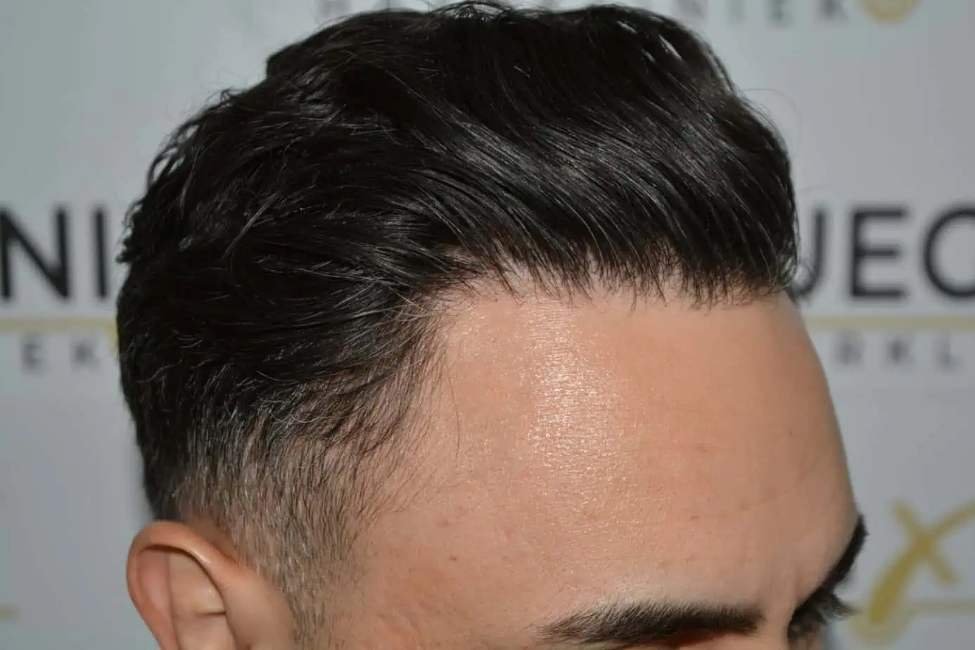 The Bollywood hairline — after