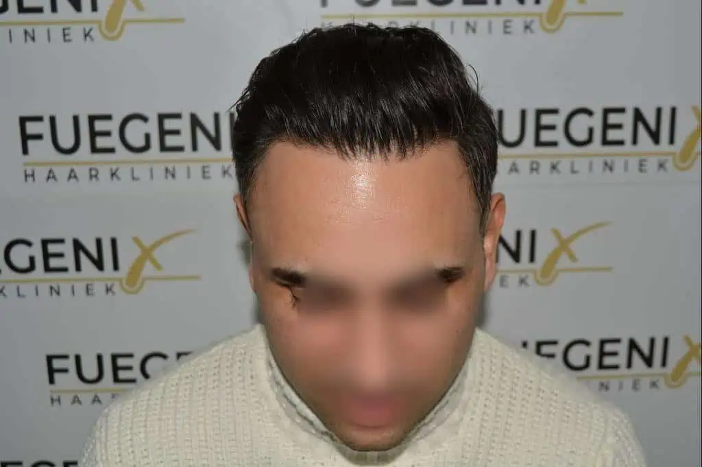 The Bollywood Hairline