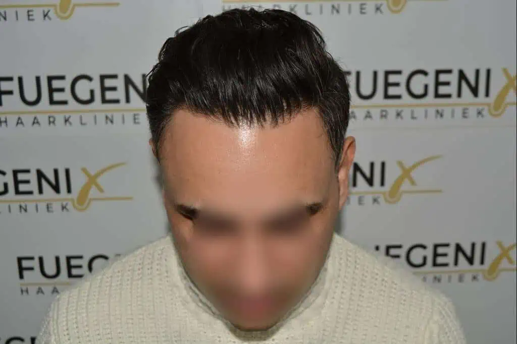 The Bollywood Hairline