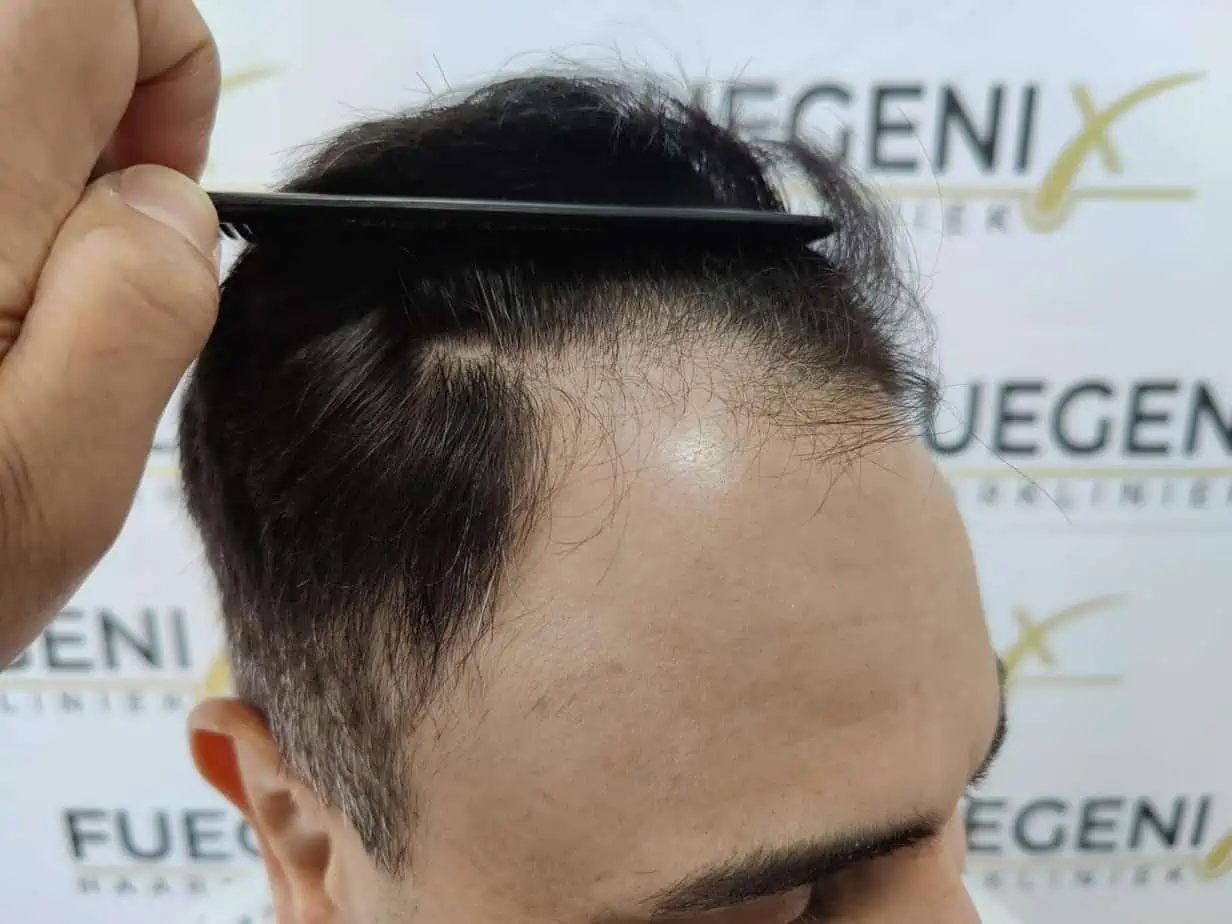The Bollywood hairline — before