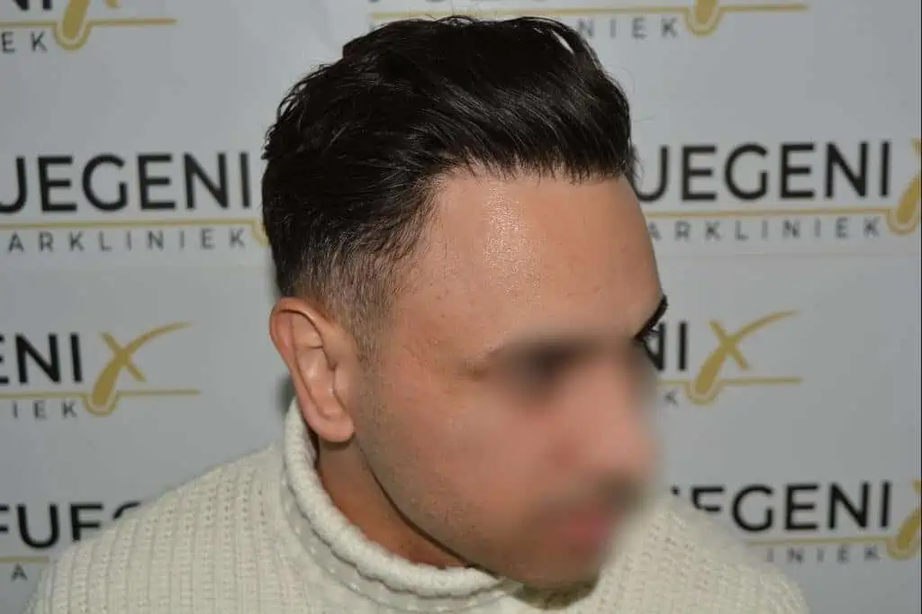 The Bollywood Hairline