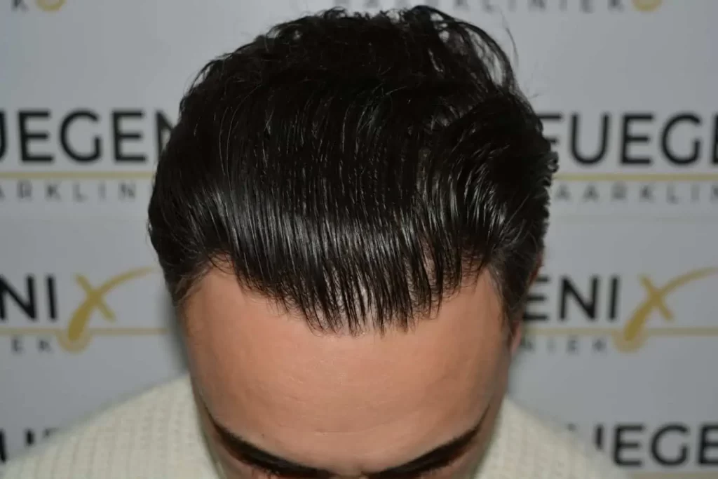 The Bollywood Hairline