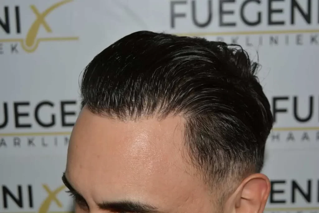 The Bollywood Hairline
