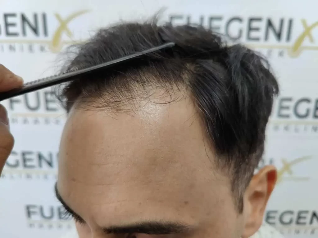 The Bollywood Hairline