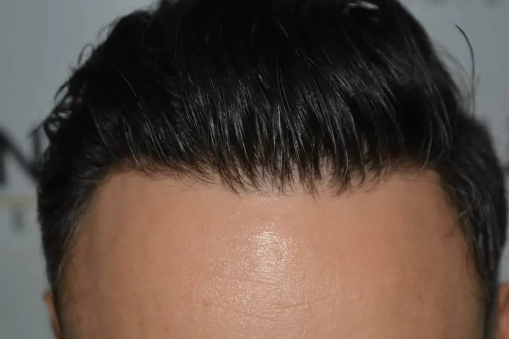 The Bollywood Hairline