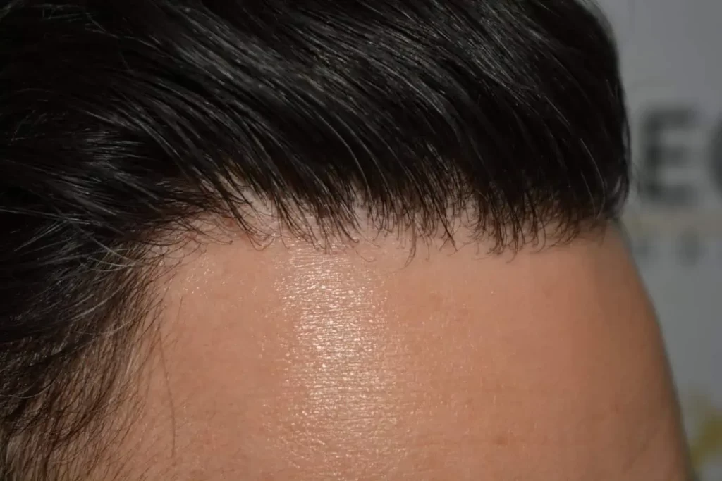 The Bollywood Hairline