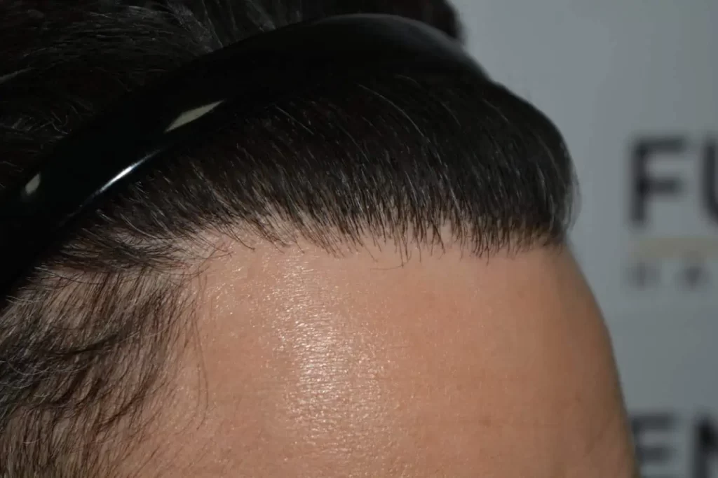 The Bollywood Hairline