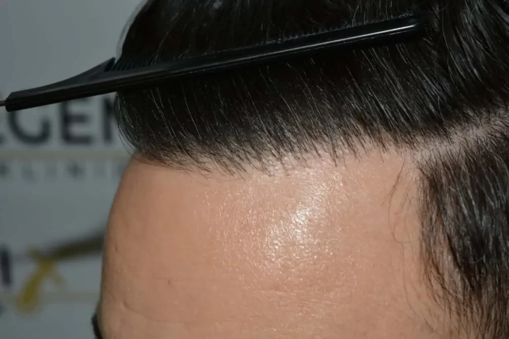 The Bollywood Hairline