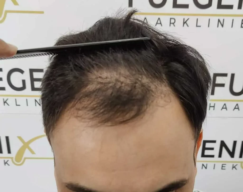 The Bollywood Hairline