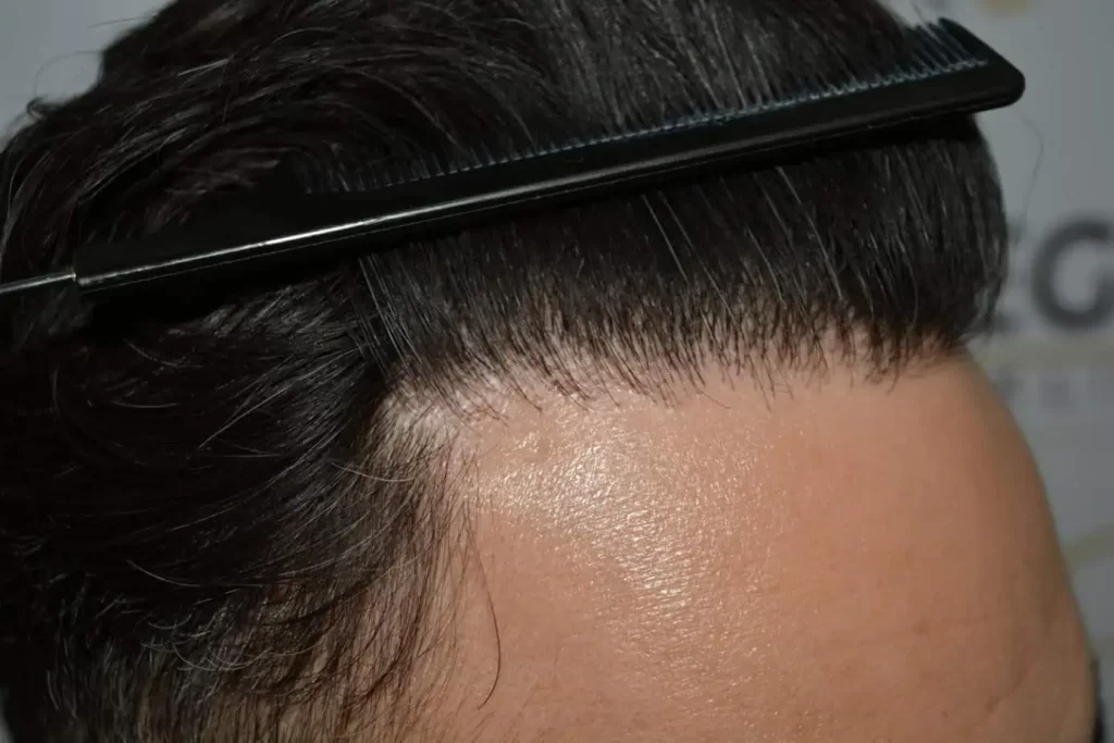 The Bollywood Hairline