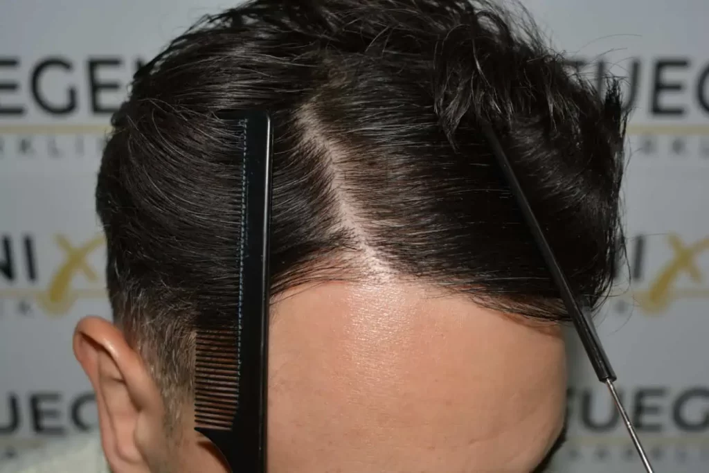 The Bollywood Hairline