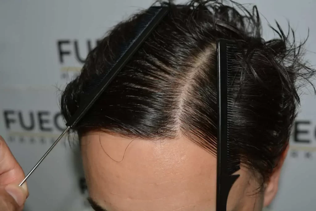 The Bollywood Hairline