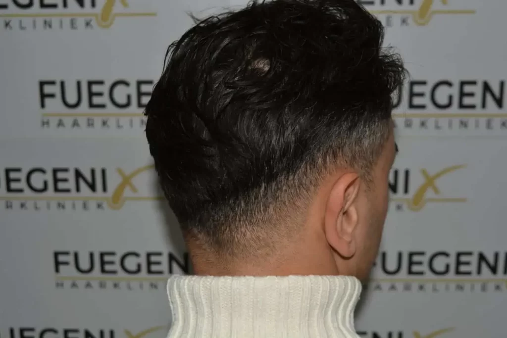 The Bollywood Hairline