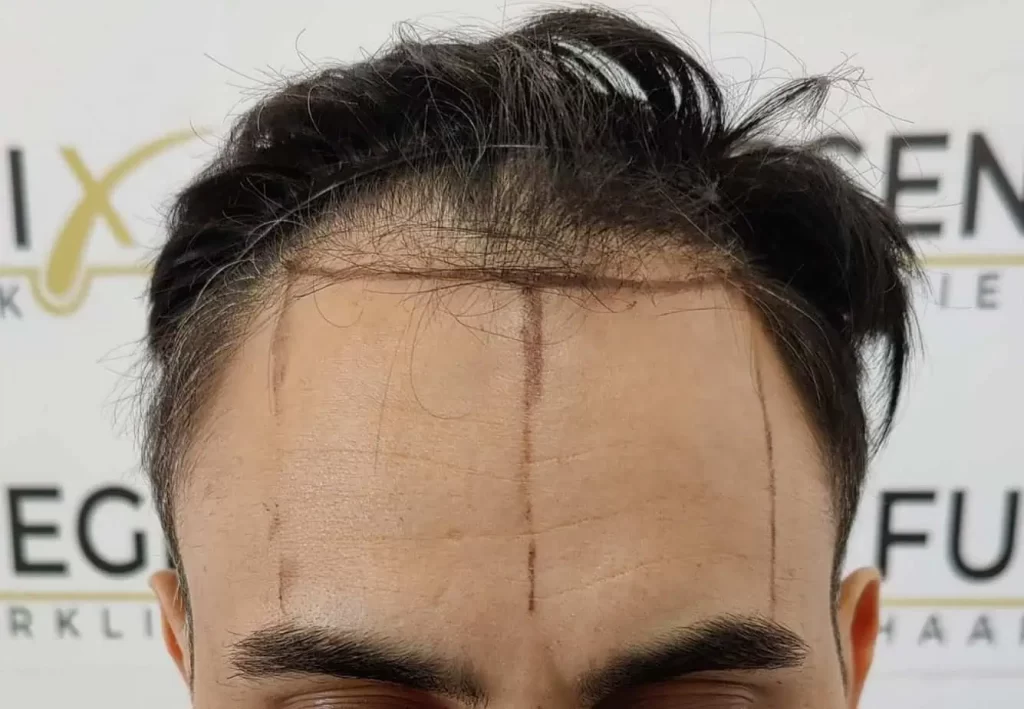 The Bollywood Hairline